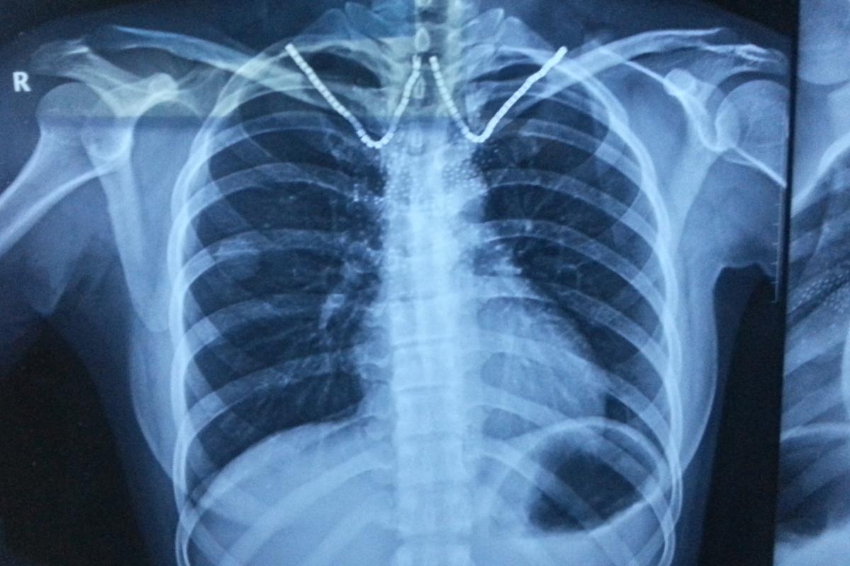 间质性肺炎听诊velcro音试听